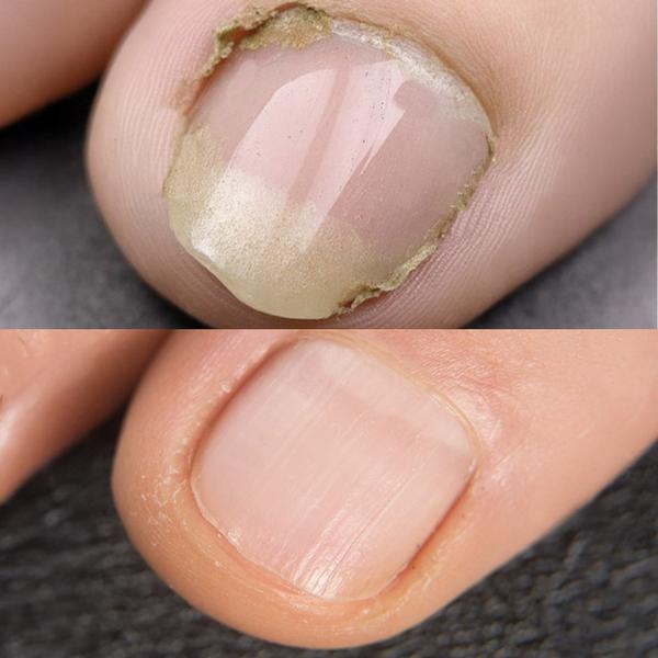 Finger mit Nagelpiz vorher und nachher