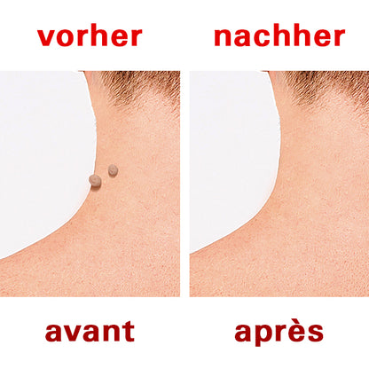 Vorher nachher Effekt des Fromu Clear anti Warzen Pflaster