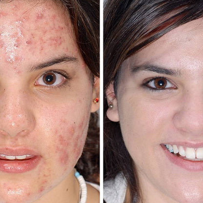 Cell-1 Skin Care hilft sichtbar gegen Akne, Alters- und Pigmentflecken
