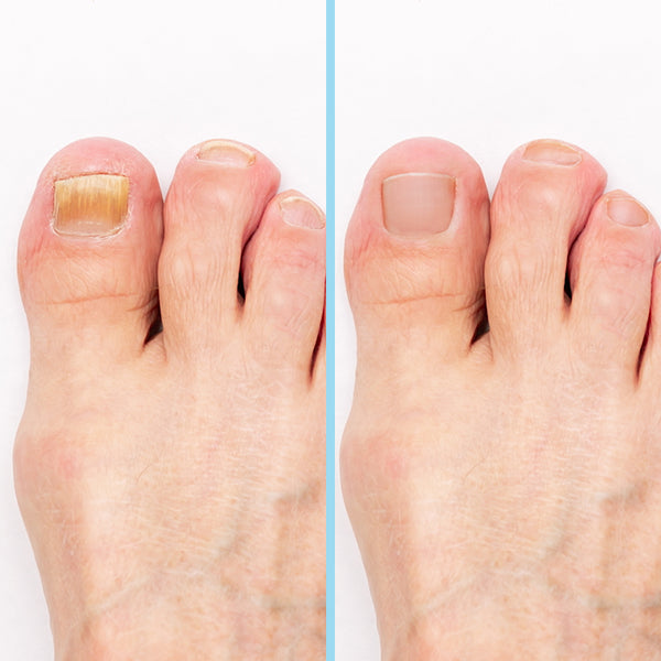 Fuss mit Nagelpilz vorher und nachher