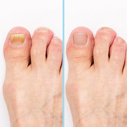 Fuss mit Nagelpilz vorher und nachher