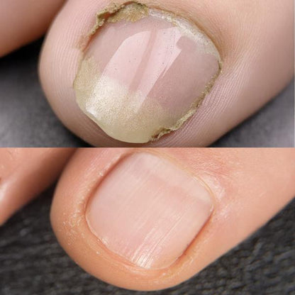 IZA Effect Anti Fuss- & Nagelpilz Spray