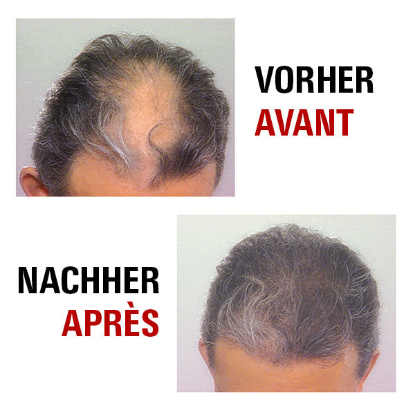 Haarwuchs vor und nach der Behandlung mit Power Grow Max