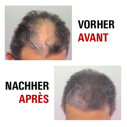 Haarwuchs vor und nach der Behandlung mit Power Grow Max