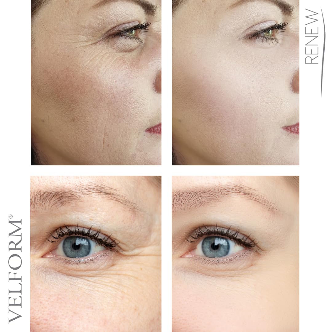 Velform Renew Vorher Nachher Bilder